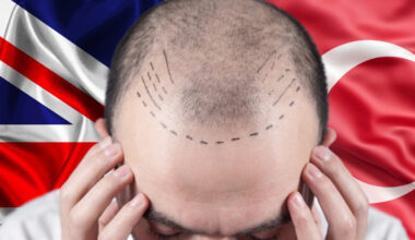 decoding hair transplant costs in turkey what really drives the price you pay