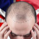 decoding hair transplant costs in turkey what really drives the price you pay