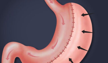 Understanding Gastric Sleeve Surgery