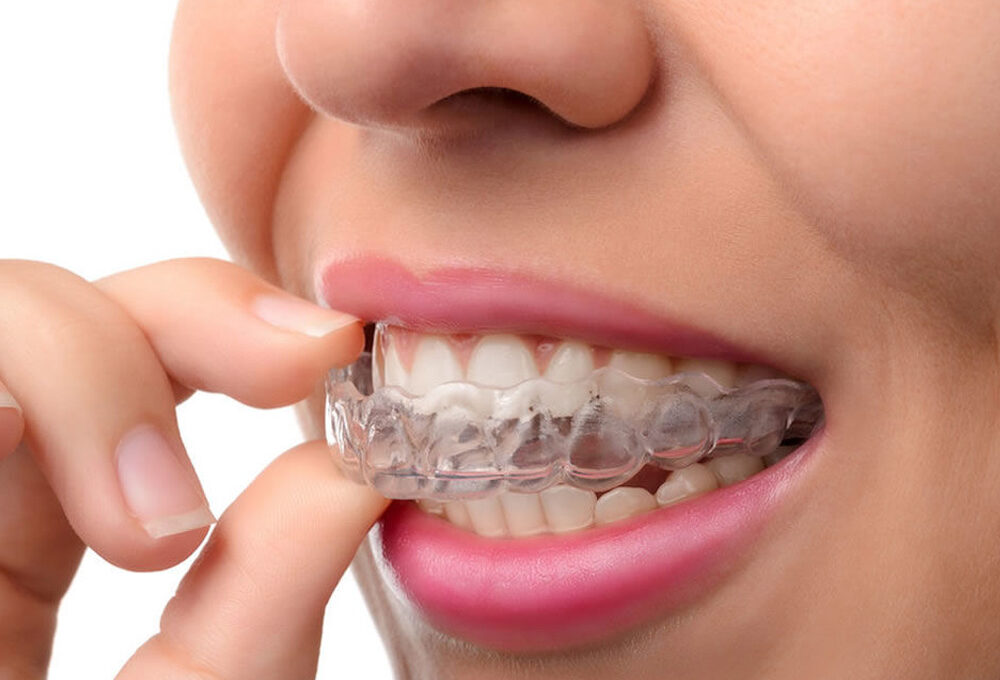 What Causes Teeth Grinding and When Nightguards May Help in West Vancouver