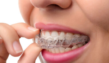 What Causes Teeth Grinding and When Nightguards May Help in West Vancouver