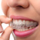 What Causes Teeth Grinding and When Nightguards May Help in West Vancouver