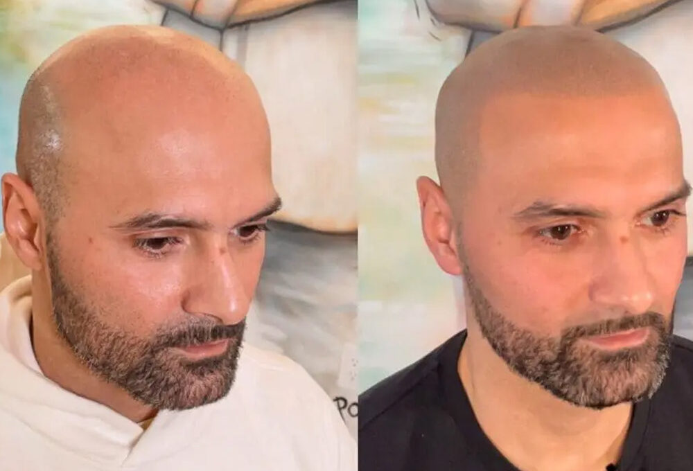 How Scalp Micropigmentation Can Enhance Your Hariline