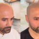 How Scalp Micropigmentation Can Enhance Your Hariline