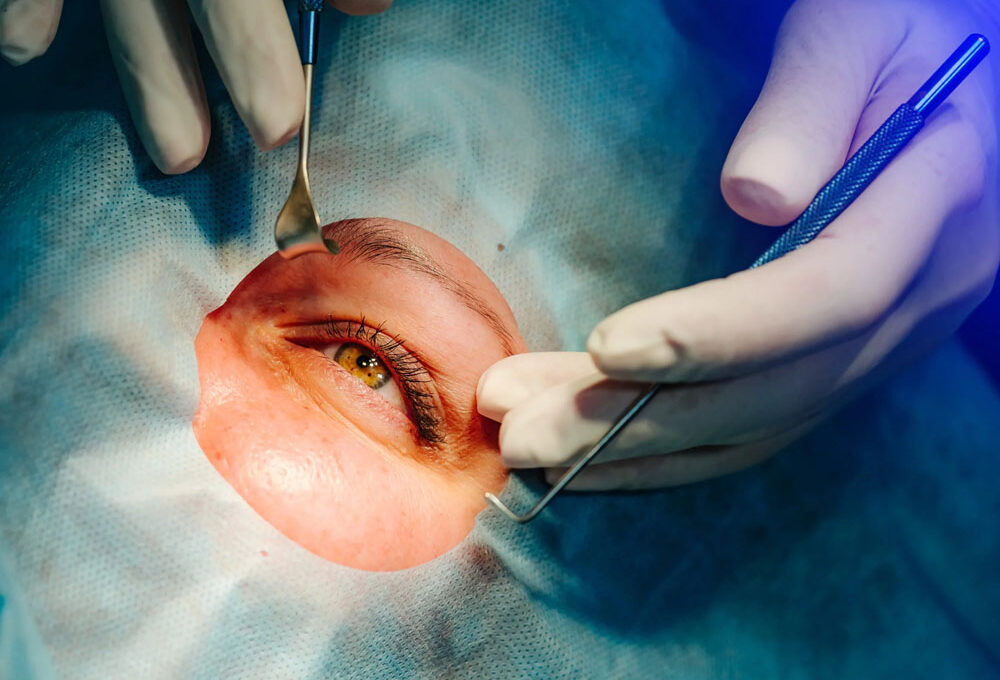 Vision Surgery