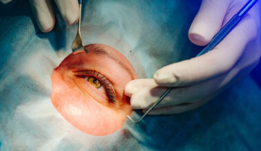 Vision Surgery