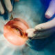 Vision Surgery
