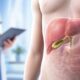 Cholecystectomy and Gallstones