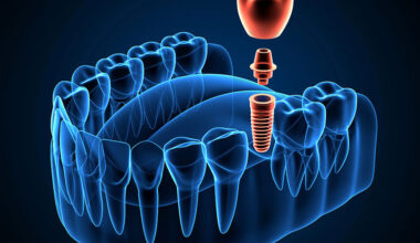 Practical Ways to Improve Dental Implant Workflows