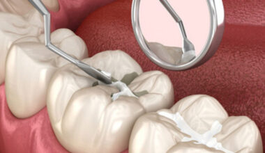 Cleanings Fillings and Crowns A Roadmap to Complete Oral Health