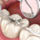 Cleanings Fillings and Crowns A Roadmap to Complete Oral Health