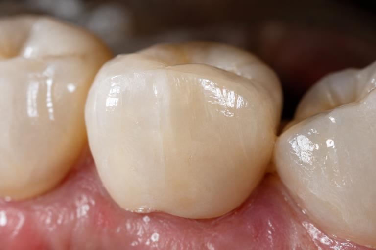 Dental Restorations in Champaign, Illinois: How Materials, Habits, and Follow-Up Shape Everyday Results 3 Dental Restorations 2