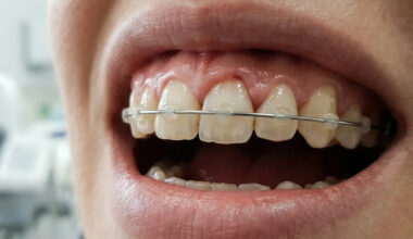 Dental Splinting After An Injury How Loose Teeth Are Supported During Healing