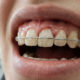 Dental Splinting After An Injury How Loose Teeth Are Supported During Healing