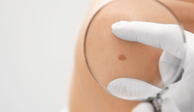 Skin Cancer Checks and Your Skin Type What Most Australians Get Wrong