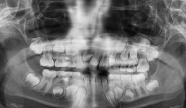 Why A Child May Need A Panoramic X Ray To Locate An Unerupted Tooth