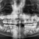 Why A Child May Need A Panoramic X Ray To Locate An Unerupted Tooth